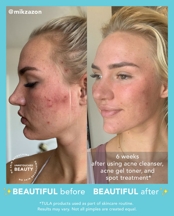 level 1 acne clearing routine